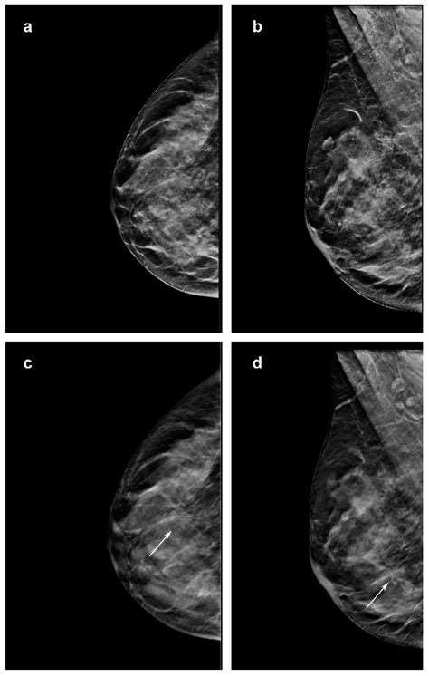 Effect of Digital Mammography for Breast Cancer Screening: A.